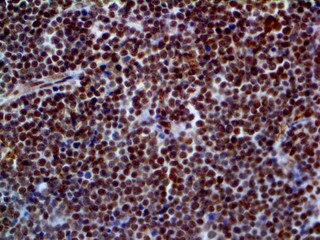 IHC of ERCC1 on an FFPE Lymphoblastic Lymphoma Tissue